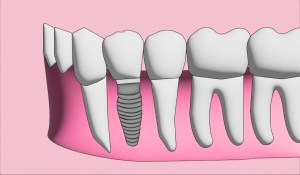 illustration of an implant